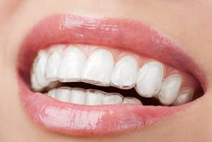 ortodoncja aparat CLEAR ALIGNER