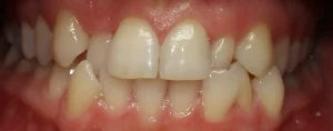 Ortodoncja - Clear Aligner