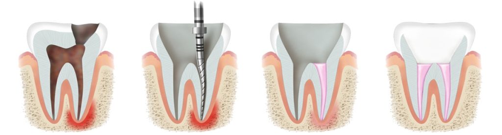 Proces leczenia kanałowego endodontycznego.