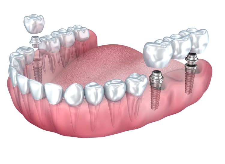 3D dolne zęby i implant dentystyczny przezroczysty render na białym tle